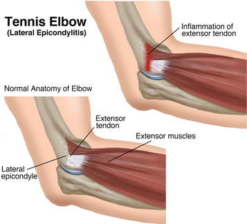 tennis elbow lateral epicondylitis richmond