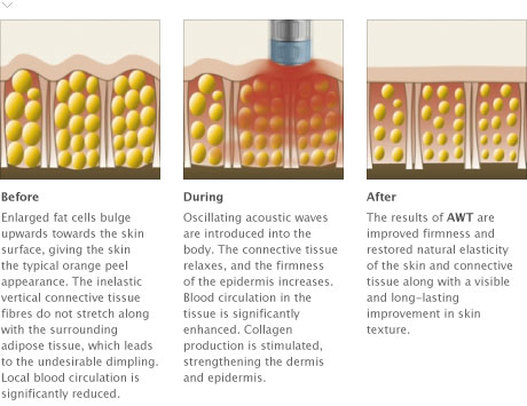 cellulite removal fat shockwave treatment