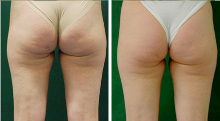 physiotherapy cellulite treatment vancouver
