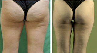 improve cellulite thigh richmond 