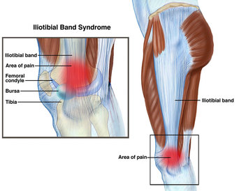 iliotibial band syndrome cure