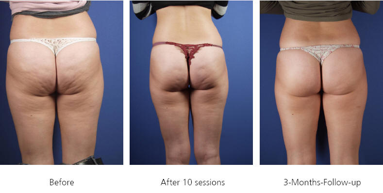 cellulite removal richmond firm 