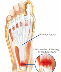 foot pain relief richmond physiotherapy