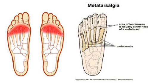 metatarsalgia foot pain treatment richmond