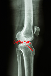osgood schlatter cure vancouver