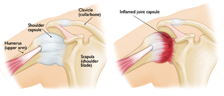 frozen shoulder physiotherapy vancouver