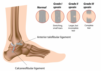 ligament sprain vancouver physiotherapy 
