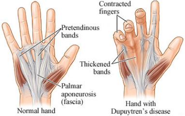 dupuytren's contracture physiotherapy