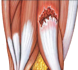 muscle tear richmond physiotherapy treat