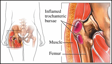 granville hip treatment bursitis pain