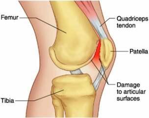 knee pain treat richmond physio