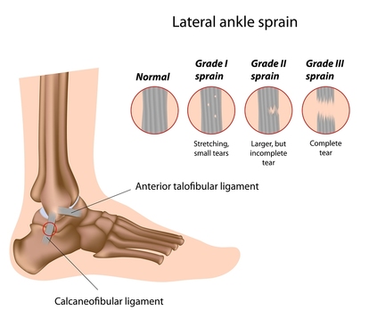 sprain treatment physiotherapy richmond ligament