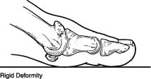 marpole stiff toe pain relief physio