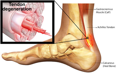 achilles tendonitis pain relief physiotherapy richmond