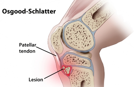 osgood schlatter physiotherapy vancouver
