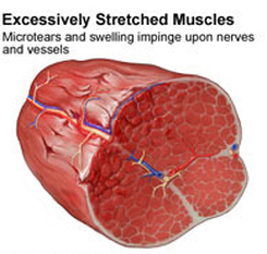 muscle pull shockwave vancouver