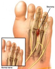 Morton's neuroma physiotherapy vancouver