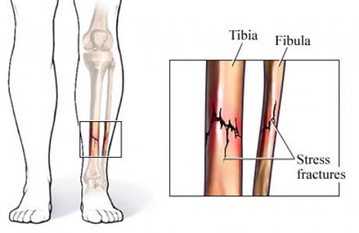 stress fracture tibia physiotherapy treatment richmond